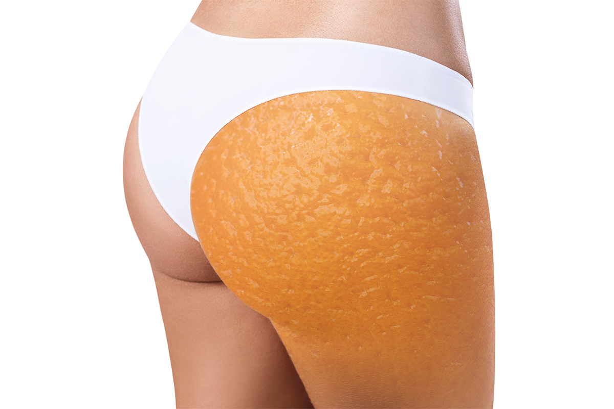 How to Get Rid of Cellulite (Cellulite Treatment Methods) - Medical Wave